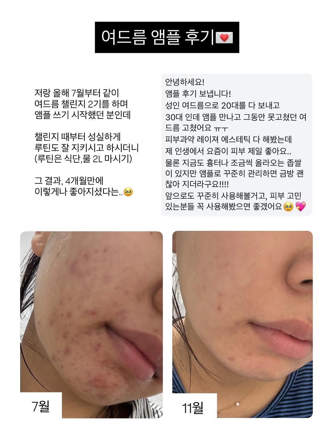 Photo by 모리녀 | 모든 걸 리뷰하는 여자 on November 11, 2025. May be an image of text that says '여드름 앰플 후기 저랑 올해 7월부터 같이 여드름 챌린지 2기를 하며 앰플 플쓰기시작했던 쓰기 시작했던 분인데 챌린지 때부터 성실하게 루틴도 잘지키시고 하시더니 (루틴은 식단,물 2L 마시기) 안녕하세요! 앰플 후기 보냅니다! 성인 여드름으로 20대를 다 보내고 30대 인데 앰플 만나고 그동안 못고쳤던 여 드름 고쳤어요 ㅠㅜ 피부과약 레이져 에스테틱 다 해봤는데 제 인생에서 요즘이 피부 제일 좋아요.. 물론 지금도 흉터나 조금씩 올라오는 좁쌀 있지만 앰플로 꾸준히 관리하면 금방 괜 찮아 지더라구요!!!! 앞으로도 꾸준히 사용해불거고, 피부 고민 있는분들 꼭 사용해봤으면 좋겠어요 그 결과, 4개월만에 이렇게나 좋아지셨다는 7월 11월'.