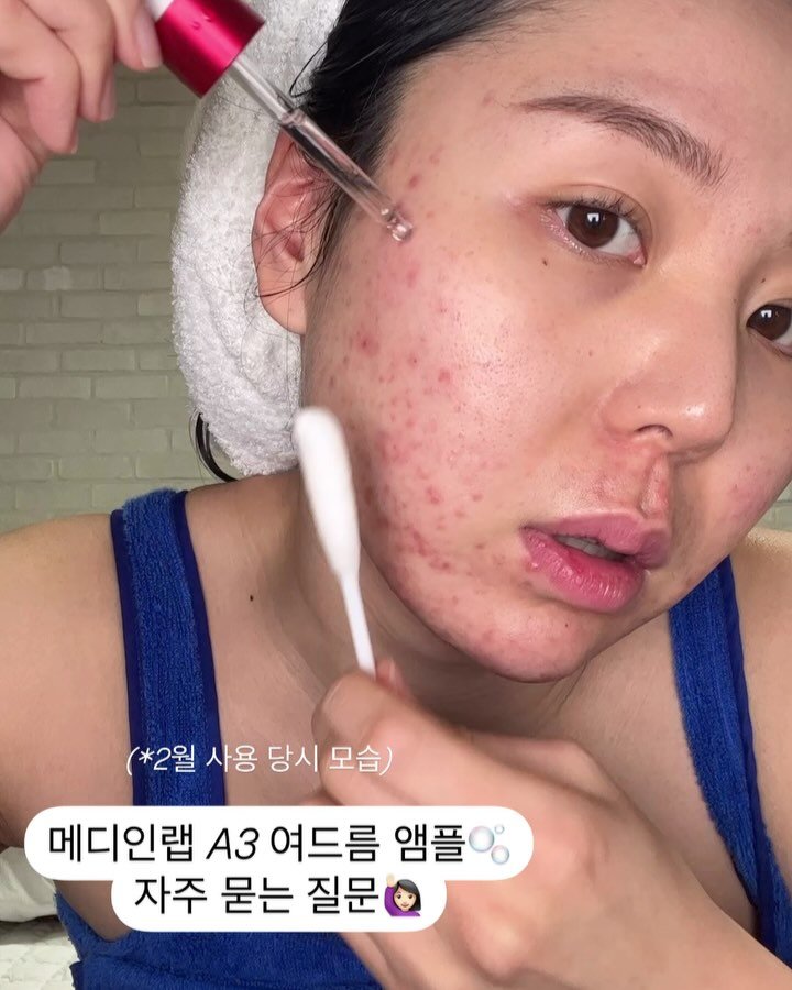 morinyeo 게시물 이미지: #오픈 여드름 앰플 자주 묻는 질문들 정리해 봤어요!
이 외에 질문들은 댓글...