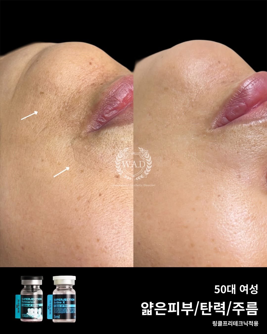 Photo shared by 슈퍼젝션 1st | 홈케어전문가 | 세멘잘 • 루티너 • 파이토신 | 파메스티틱 슈퍼젝션교육 뮤리엘대표 오한솔 on December 01, 2025 tagging @muri_l_official, and @muri_l__ceo. May be an image of text that says 'WA.D lintir Directer မ်် Tiek 180 SUPERJECTION HE 아에클러A M eeed D0lngi C 5ml 50대 여성 얇은피부/탄력/주름 얇은피부/ 랩 탄력 탄력/주름 주름 링클프리테크닉적용'.