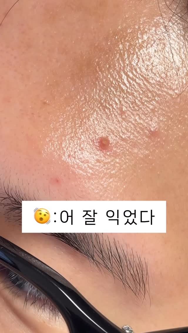 olheum_ceo 게시물 이미지: 압출하고 나서 빨갛게 달아오를때 있죠 😳
그 상태에서 발라봤어요

픽시카겔 딱 한번...
