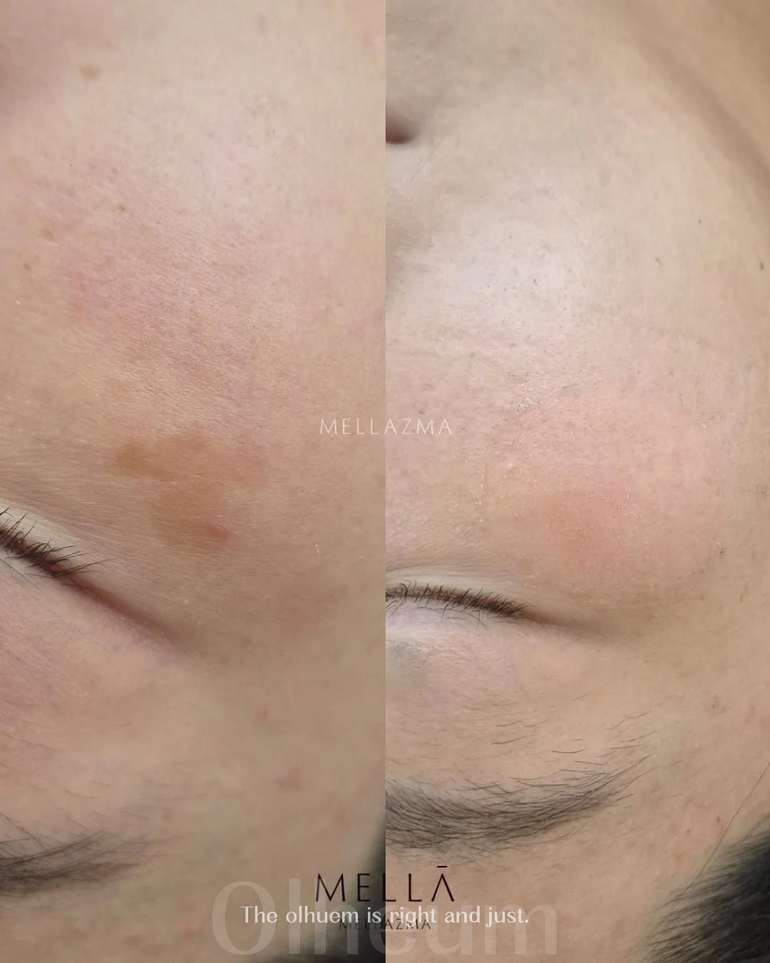 Photo shared by 옳음 에스테틱 유나연 | 피부훈련소•요철,좁쌀 여드름 홈케어 on November 11, 2025 tagging @olheum__skin. May be an image of text that says 'MELLAZMA ZMA MELLA M M LÀ Theolhuem The.lhuomisrigh.andjust. The olhuem IS right and just.'.