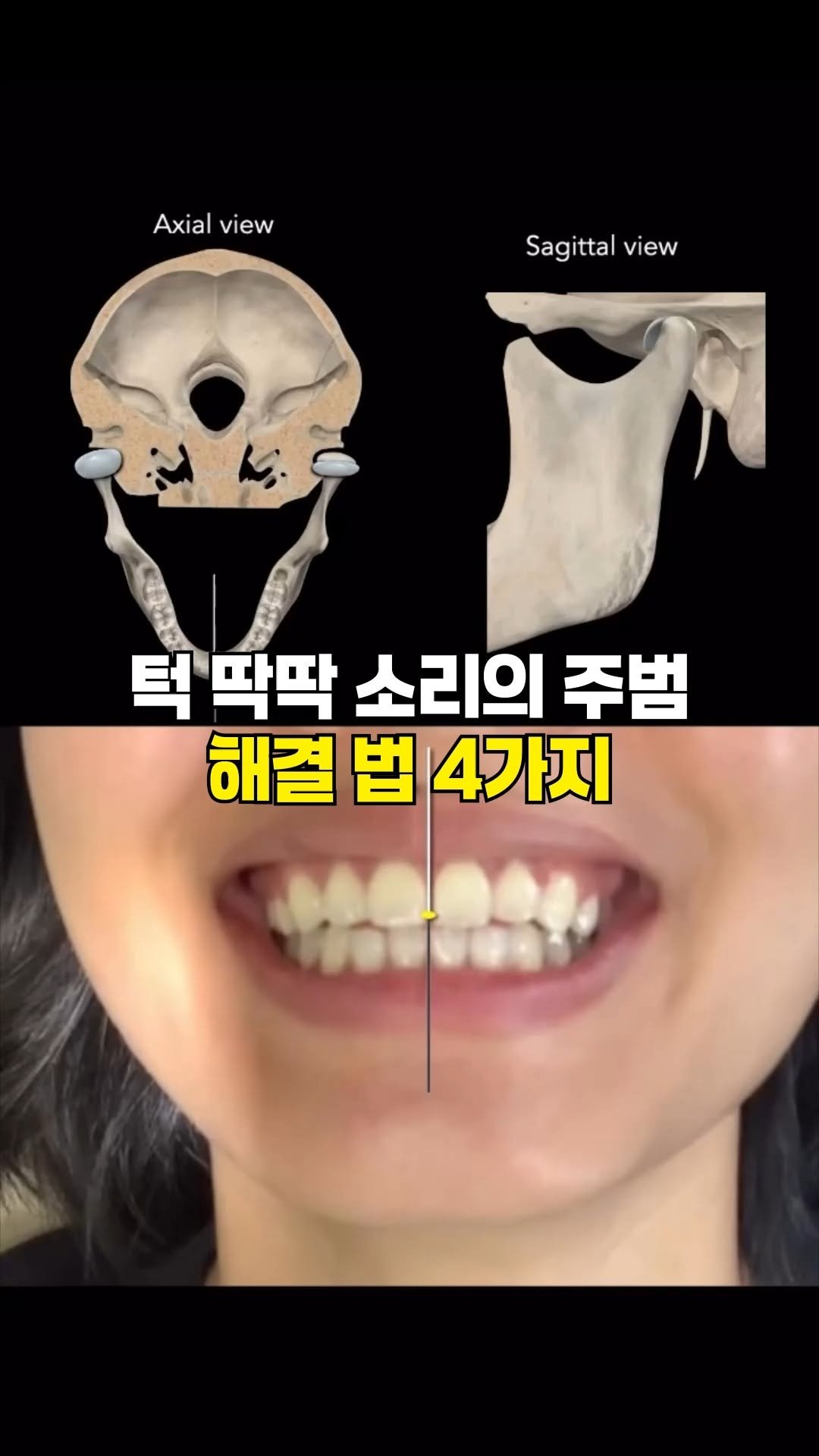 one_dosu_physio 게시물 이미지: 딱딱거리는 턱, 굳은 턱 근육 1분에 푸는 셀프 관리 4가지!

스트레스로 이를...