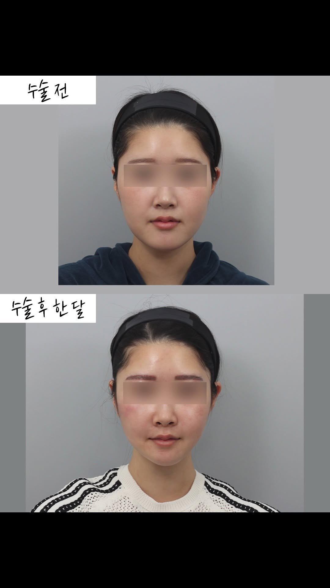 onul_ps 게시물 이미지: 오늘의수술
윤곽3종+심부볼제거
곽인수 원장님

뼈가 작아져도 연부 조직이...