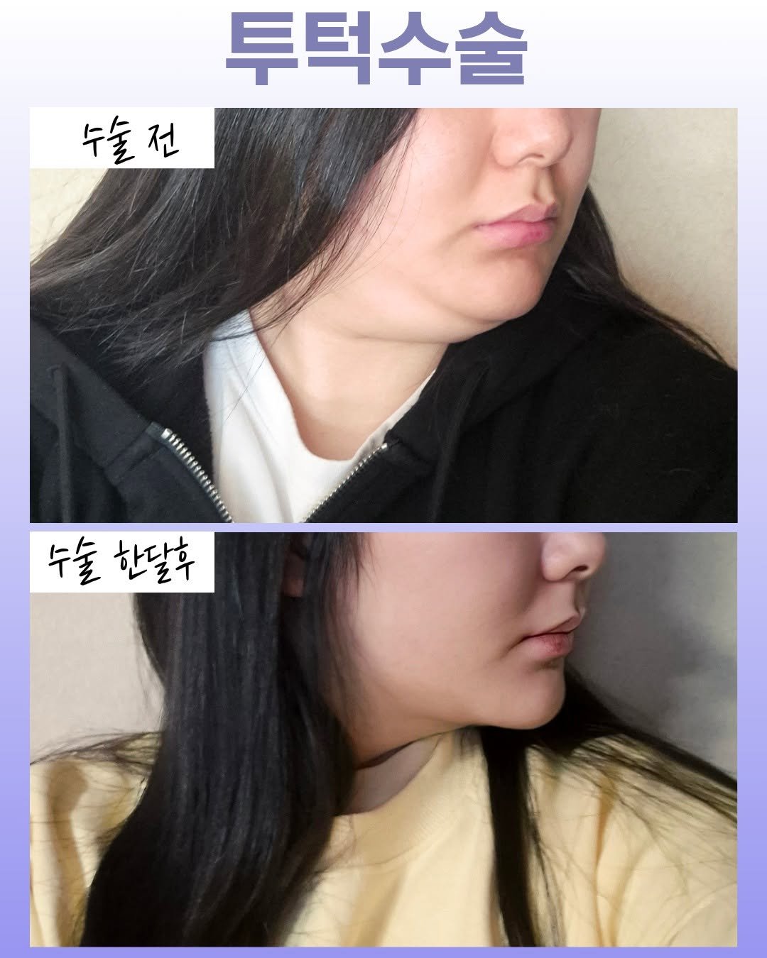 onul_ps 게시물 이미지: #이중턱제거 
다이어트를 해도,레이저리프팅을 해봐도
효과를 볼 수 없었던...