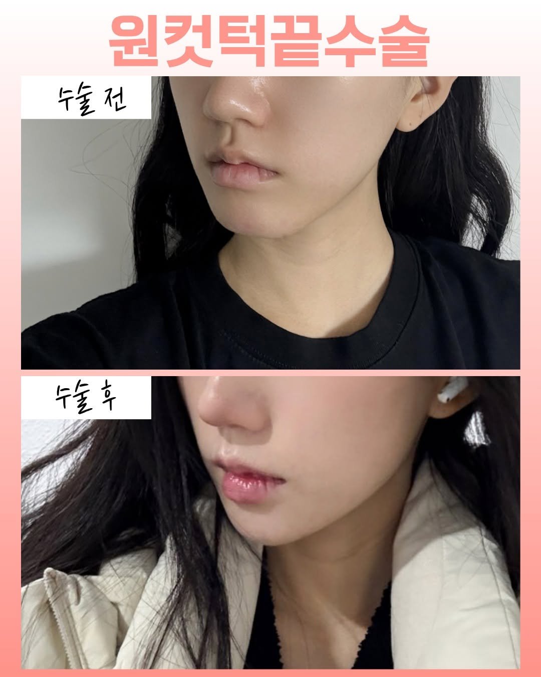 onul_ps 게시물 이미지: #원컷턱끝축소
턱끝이 각진형태는 얼굴 전체적으로 남성적으로 보일 수...
