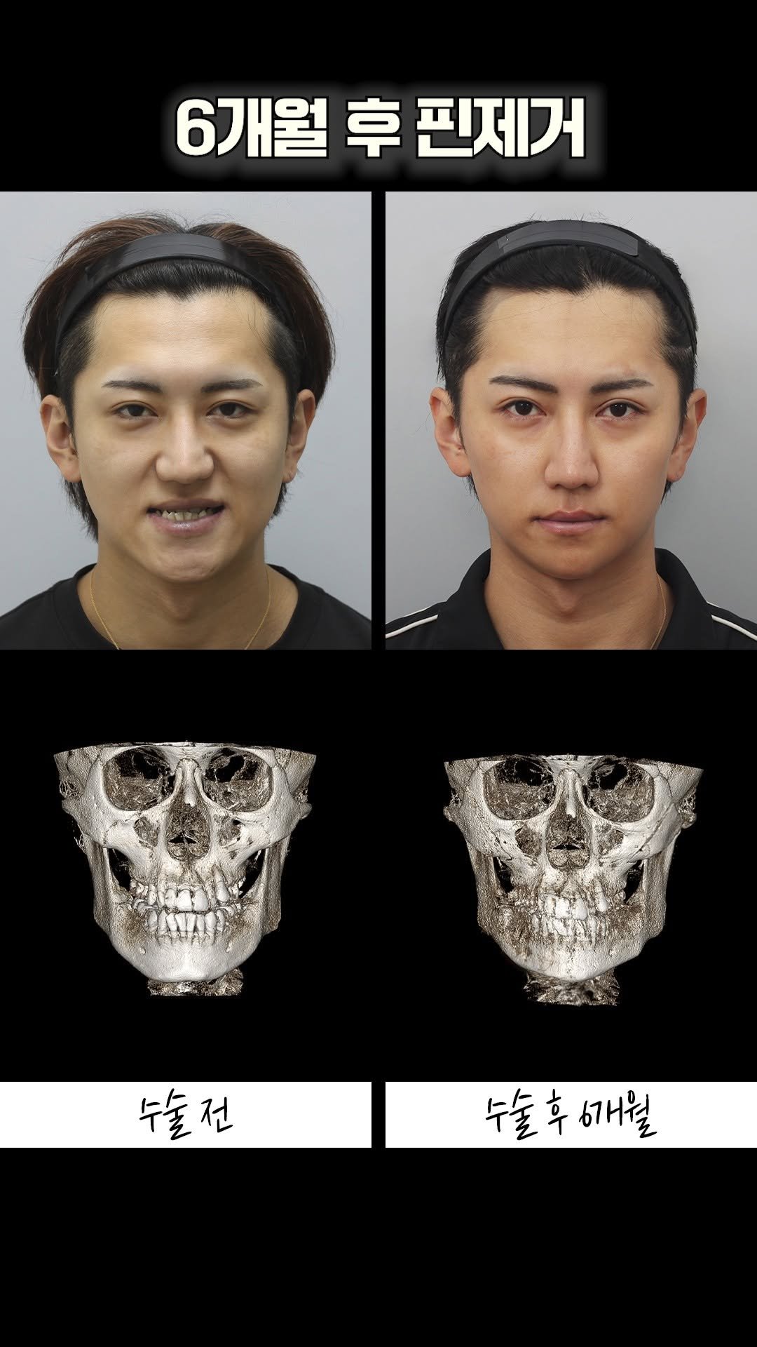 onul_ps 게시물 이미지: 오늘의수술
하악교정(SSRO)+원컷턱끝
곽인수원장님

치아 교정 없이 하악...