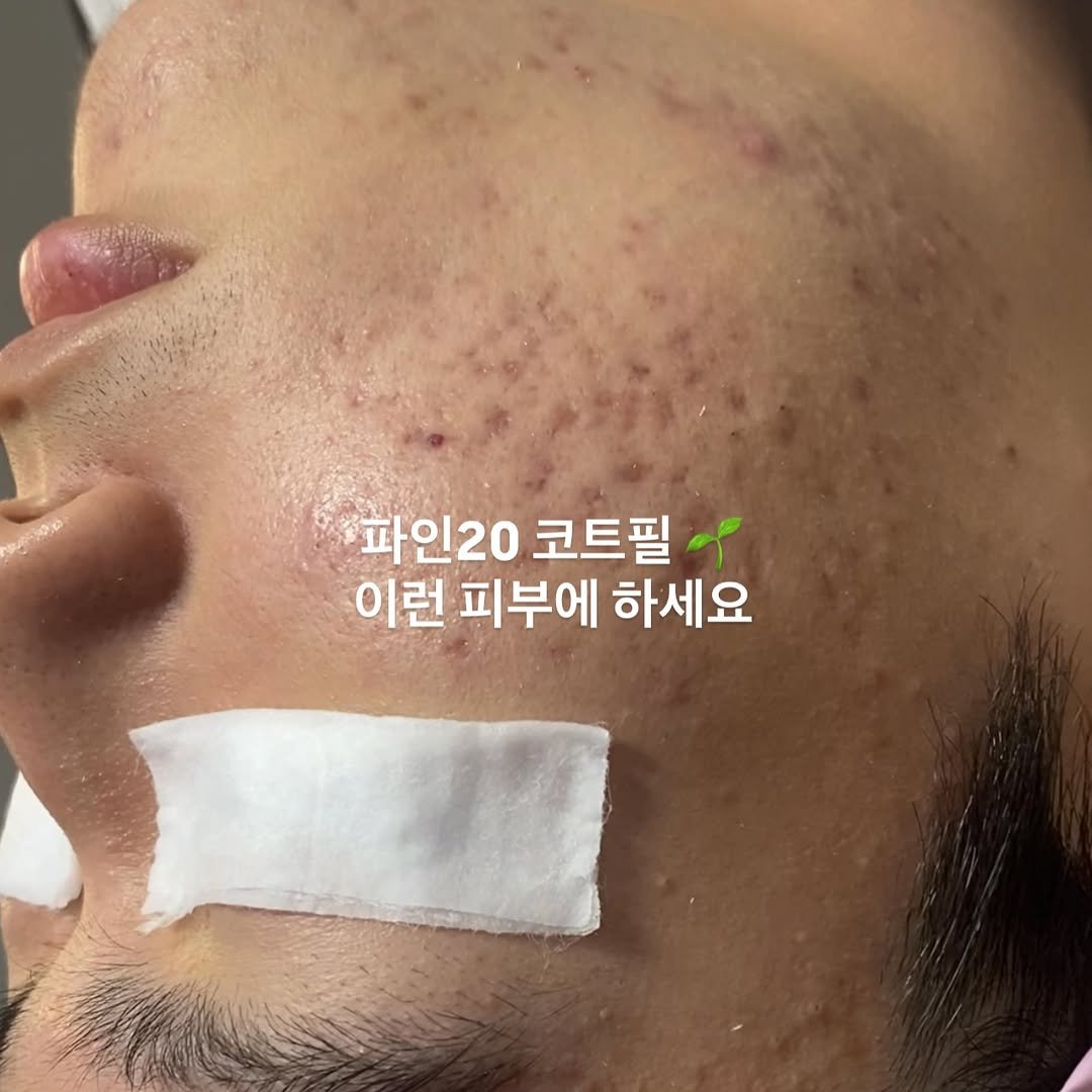 Photo by 박정민/여드름/문제성피부전문가 on January 08, 2026. May be an image of text that says '파인20 파인20코트필 코트필 이런 피부에 하세요'.