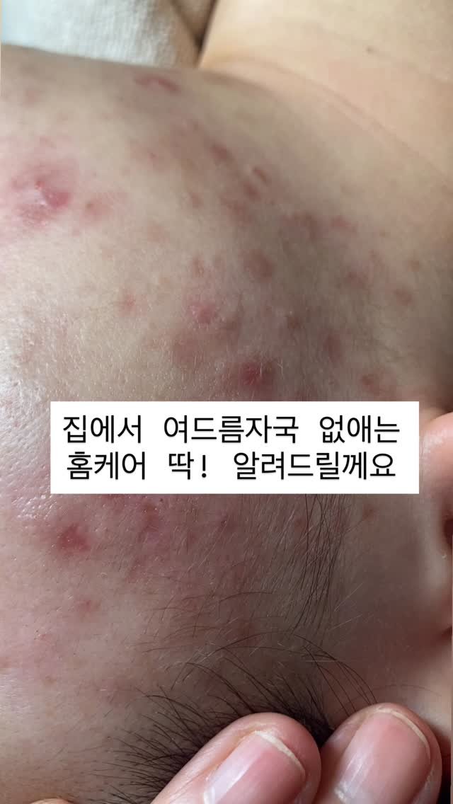 peau_jungmin5709 게시물 이미지: 현 피부전공 대학교수의 포커스홈케어 코칭

어렵게 생각하지말고 주2.3회...