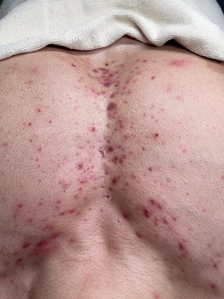 peau_jungmin5709 게시물 이미지: (현 피부전공 대학교수의 문제성피부관리)

영상으로 다 표현이 안되어...