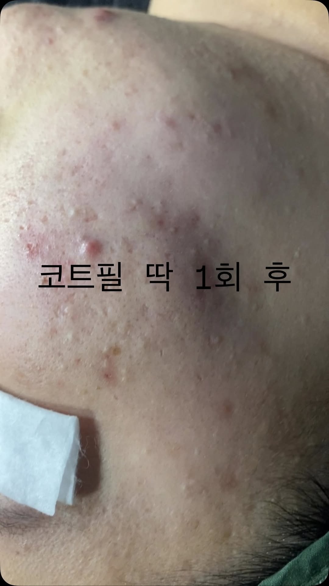 peau_jungmin5709 게시물 이미지: (현 피부전공 대학교수의 문제성피부관리)

코트필을 개발한 이유

딱 세...