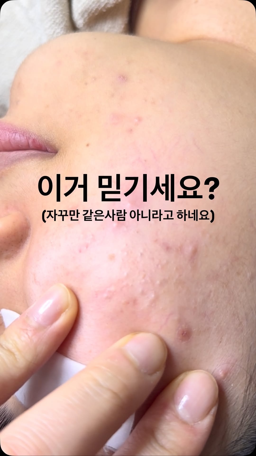 peau_jungmin5709 게시물 이미지: (현 피부전공 대학교수의 홈케어 코칭)

영상속 고객님은 해외에서...