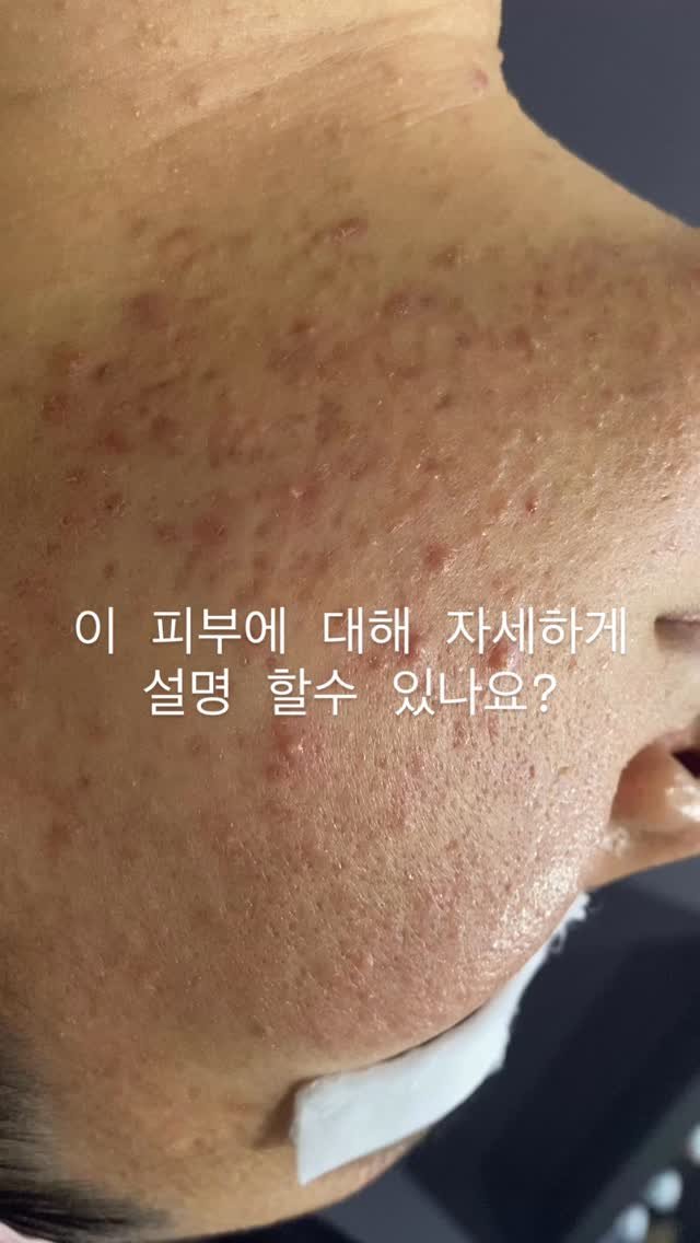 peau_jungmin5709 게시물 이미지: 여러분 

다들 속지 마세요

문제성피부는 진짜 전문가와 함께 극복하세요

세상에...
