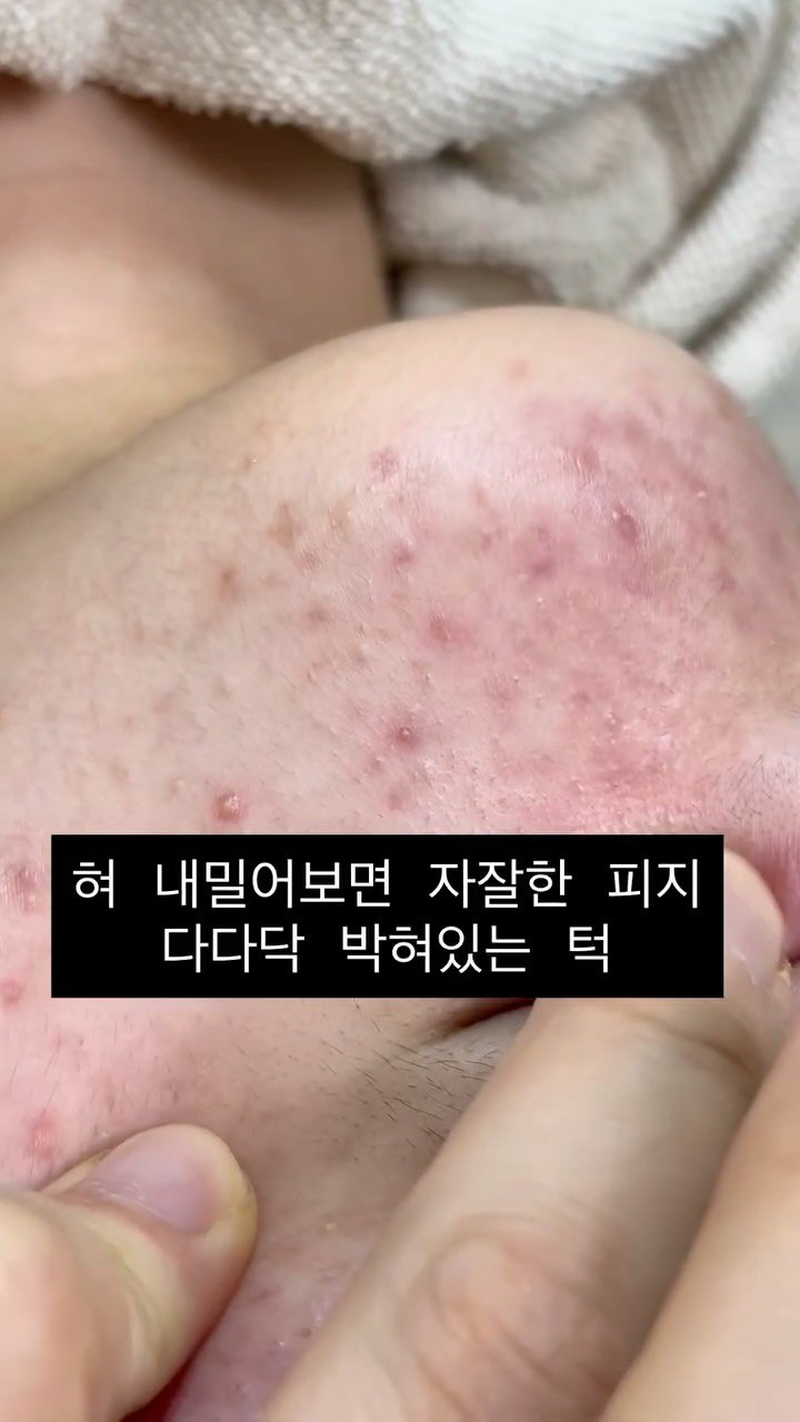 peau_jungmin5709 게시물 이미지: #제니스뷰티벅스

턱에 있는 이런 피지들은 압출을 시도하거나 하면 염증화가 잘되고...