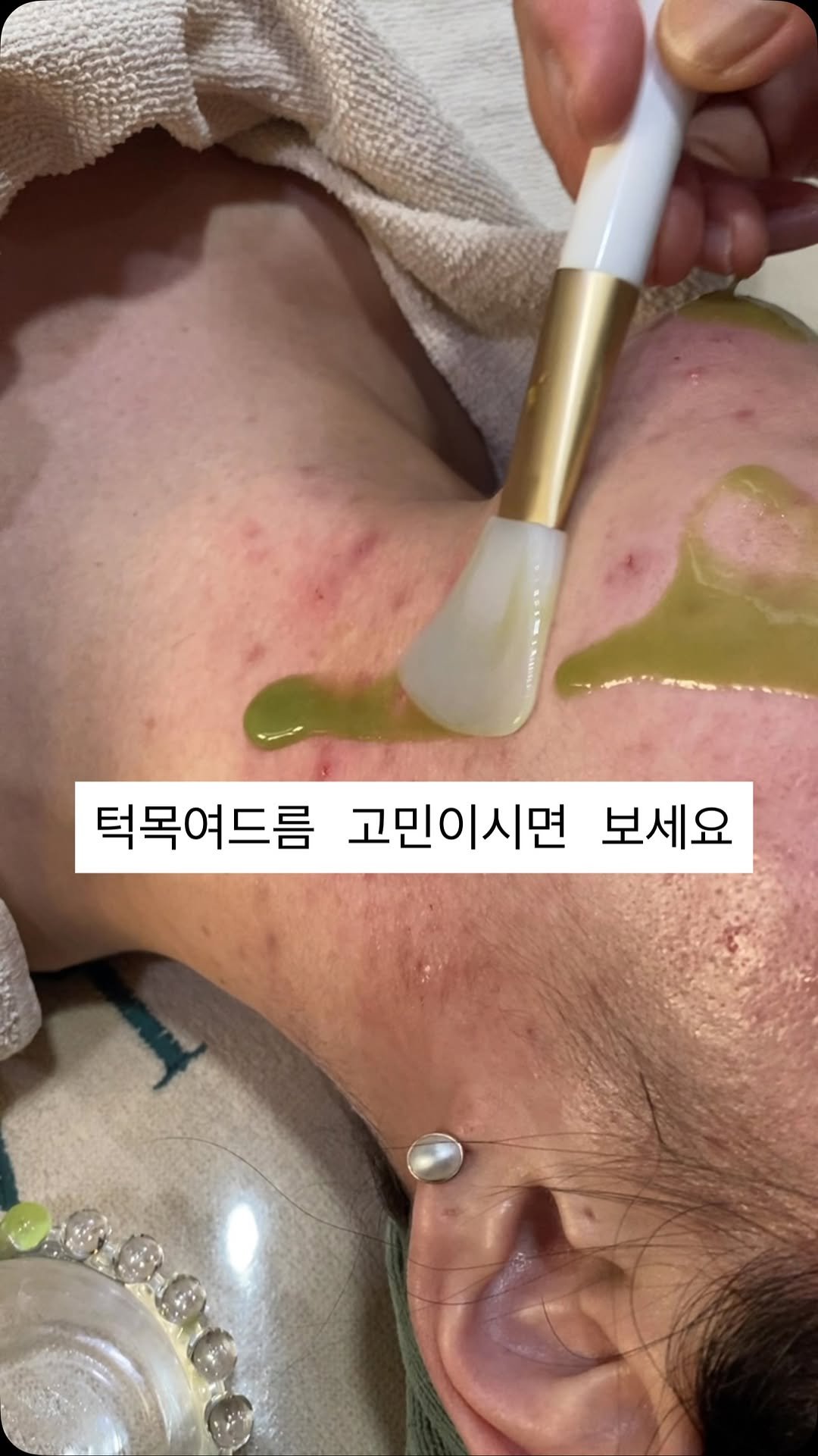 peau_jungmin5709 게시물 이미지: (현 피부전공 대학교수의 문제성피부관리)

턱목여드름으로 고민이신 고객님들도...