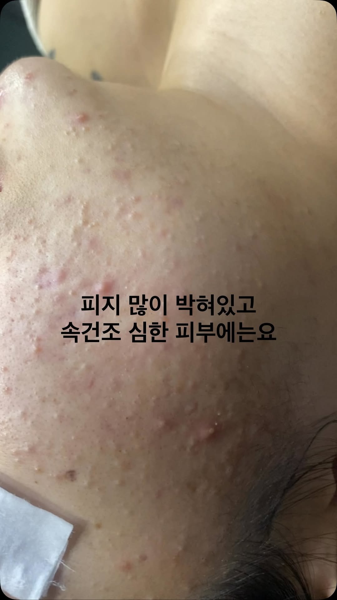 peau_jungmin5709 게시물 이미지: (현 피부전공 교수의 포커스홈케어 코칭)

피지분비량 많은데 속건조 심하신 분들에게...