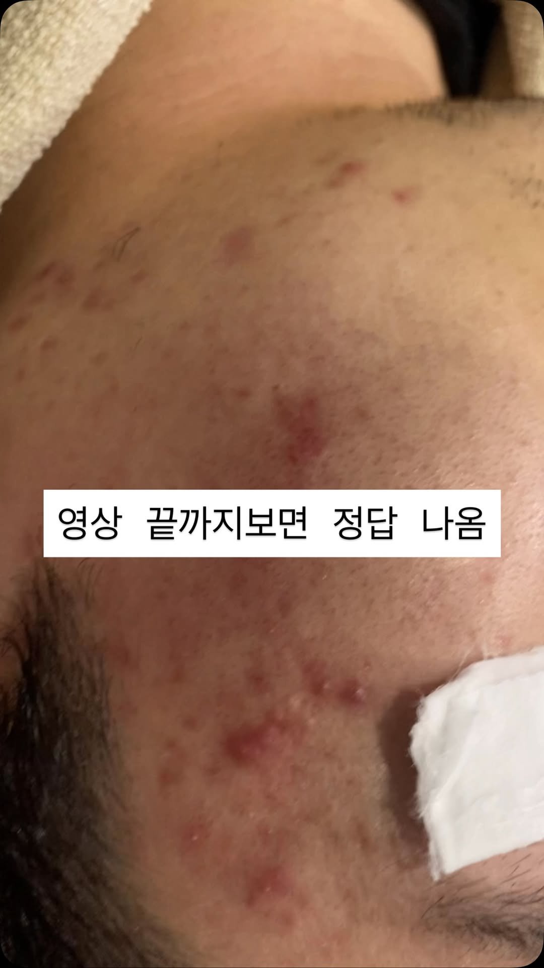 peau_jungmin5709 게시물 이미지: 항균항염 효과를 주는 조성물 기술특허출원

📌피부관리예약은 카톡 :...