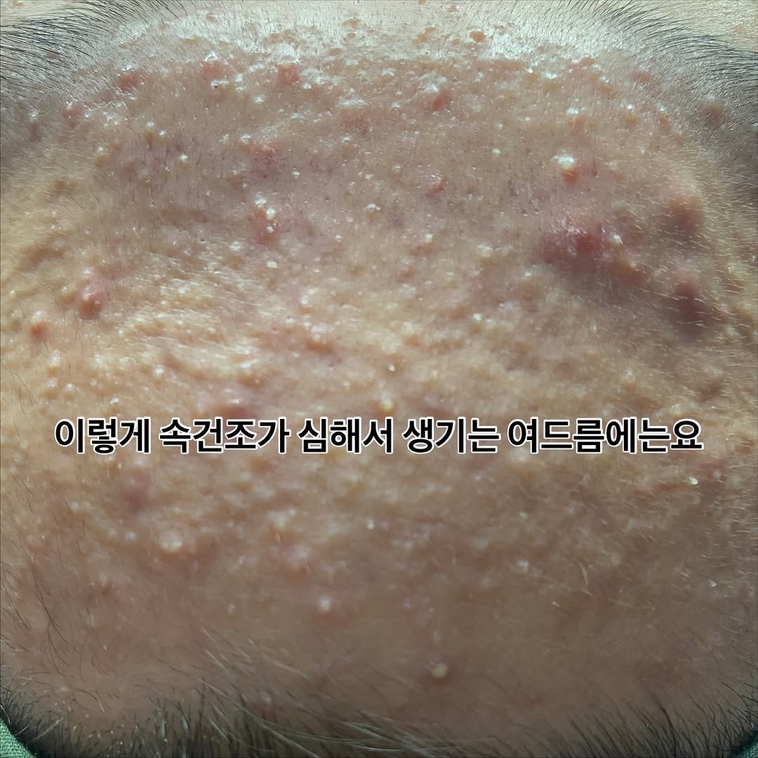 Photo by 박정민/여드름/문제성피부전문가 on November 21, 2025. May be an image of text that says '이렇게 속건조가 심해서 생기는 여드름에는요'.