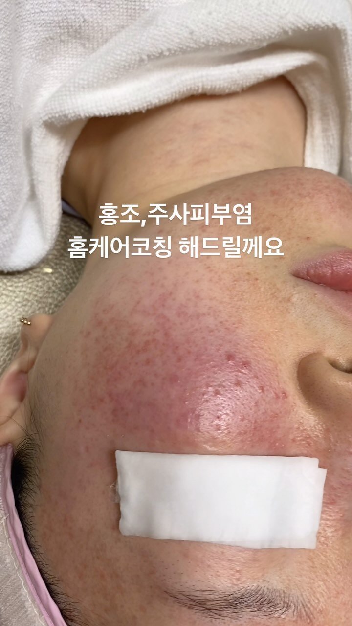 peau_jungmin5709 게시물 이미지: <실제 메디컬스킨케어교수의 포커스홈케어코칭>

홍조,극예민,주사피부염은 보습에...