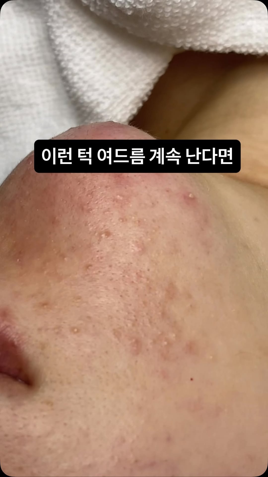 peau_jungmin5709 게시물 이미지: (현 피부전공 대학교수의 홈케어 코칭)

이런 턱여드름은 우선 속건조 부터...