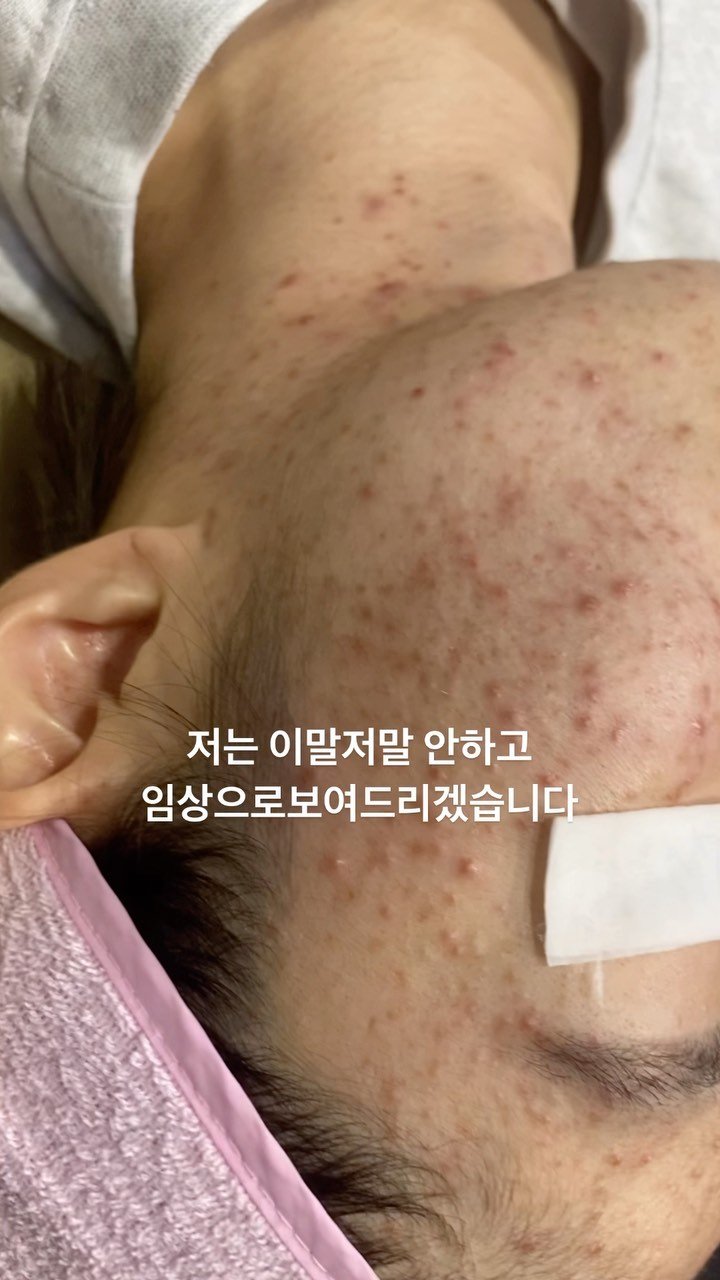 peau_jungmin5709 게시물 이미지: 제니스뷰티벅스

➡️저희고객님은 3주에 한번씩 총 7회의 관리를 받으셨고 안탈라로...