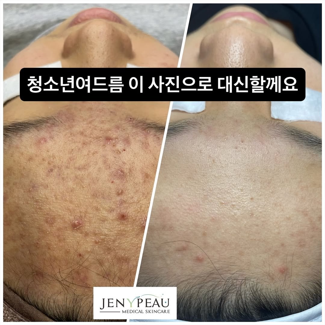 Photo by 박정민/여드름/문제성피부전문가 in Busan 釜山, South Korea. May be an image of text that says '청소년여드름 이 사진으로 대신할께요 JEN JENYPEAU JENY YPEAU MEDICAL MEDICALSKINCARE SKINCARE'.