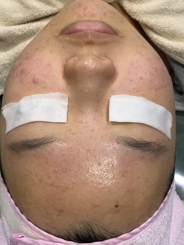 peau_jungmin5709 게시물 이미지: (현 피부전공 대학교수의 포커스홈케어 코칭)

피부결,모공,요철 때문에 고민이시라면...