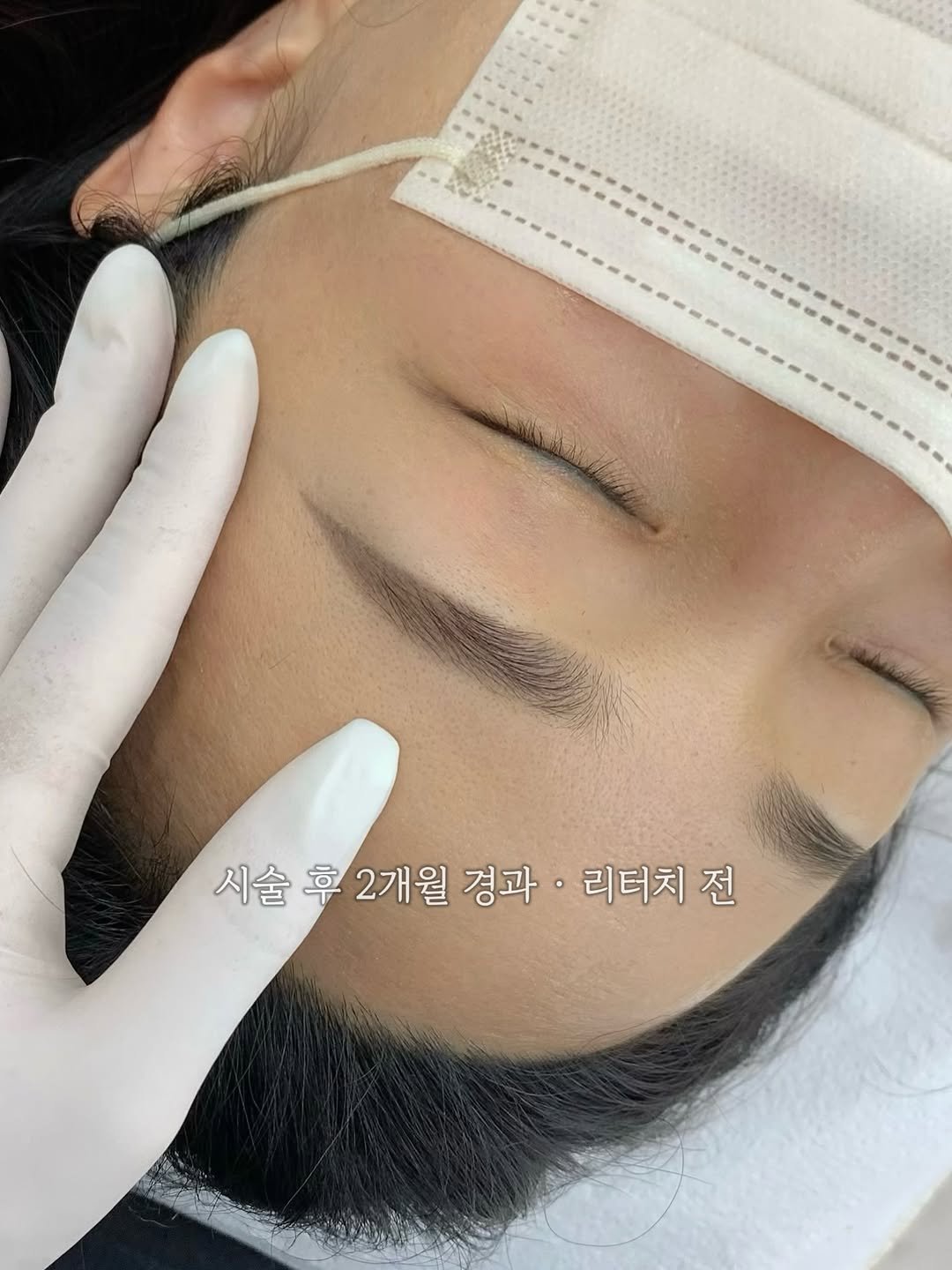 permeate_seomyeon 게시물 이미지: ✔️탈각 2개월 후, 리터치 전

리터치 예약으로 방문하셨지만,
막상 확인해보니...