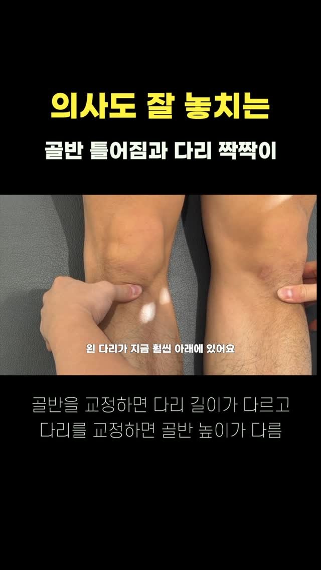 phycato_ 게시물 이미지: 이런 사람들은 다리 길이 교정하지 마세요‼️ 골반 더 틀어짐‼️