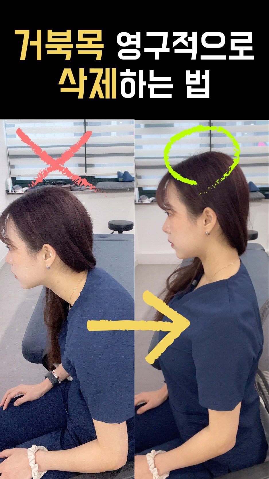 physila_sh 게시물 이미지: 🐢거북이 친구에게 보내주세요✈️✈️

거북목은 단순히 목만의 문제가 아니라, 어깨와...