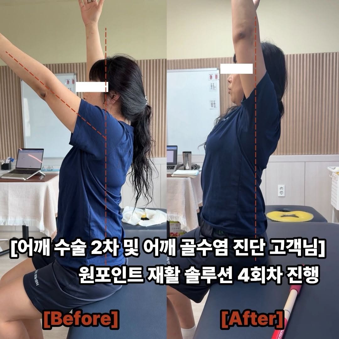 physiolution_21 게시물 이미지: [어깨 수술 2차 및 어깨 골수염 진단 고객님 원포인트 재활 솔루션 진행...
