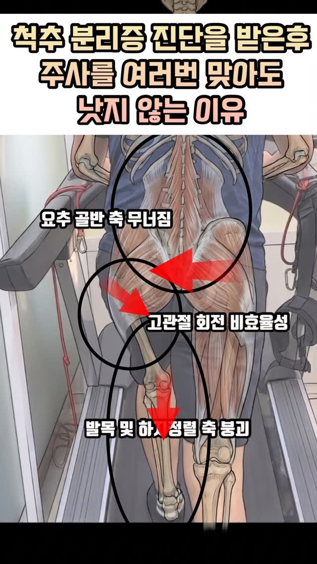physiolution_21 게시물 이미지: 척추 분리증 진단을 받고 주사를 여러번 맞아도 낫지 않는 이유

척추 분리증, 주사...
