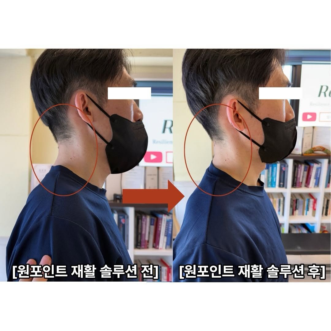 physiolution_21 게시물 이미지: [재활 솔루션 : 목디스크 환자 흉추 축 개선을 통한 경추 신전 패턴강화]

어떻게...