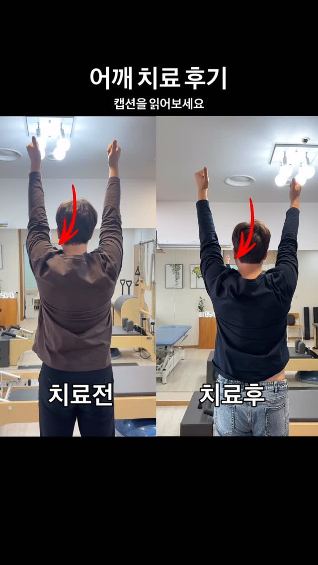 physiomoon_betterehab 게시물 이미지: 상기 환자분은 어깨의 불안정 성으로 내원해 주셨습니다

✅ 주 증상
▫️어깨가...