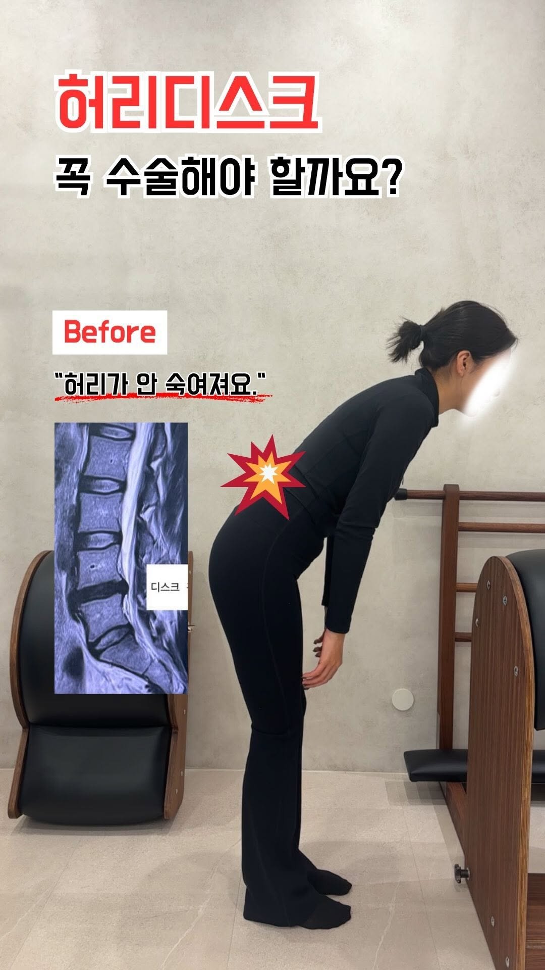 pila_jungwon 게시물 이미지: ⭐️자료 배포 EVENT⭐️

📌 허리디스크, 꼭 시술 or 수술 해야 할까?
-...