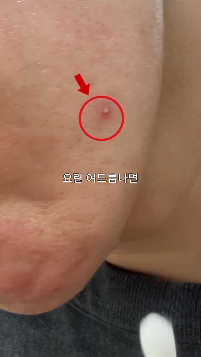 pizon_nam 게시물 이미지: 여러분은 여드름 나면 어떻게 관리하시나요?

저는 가끔씩 여드름이 생기면...