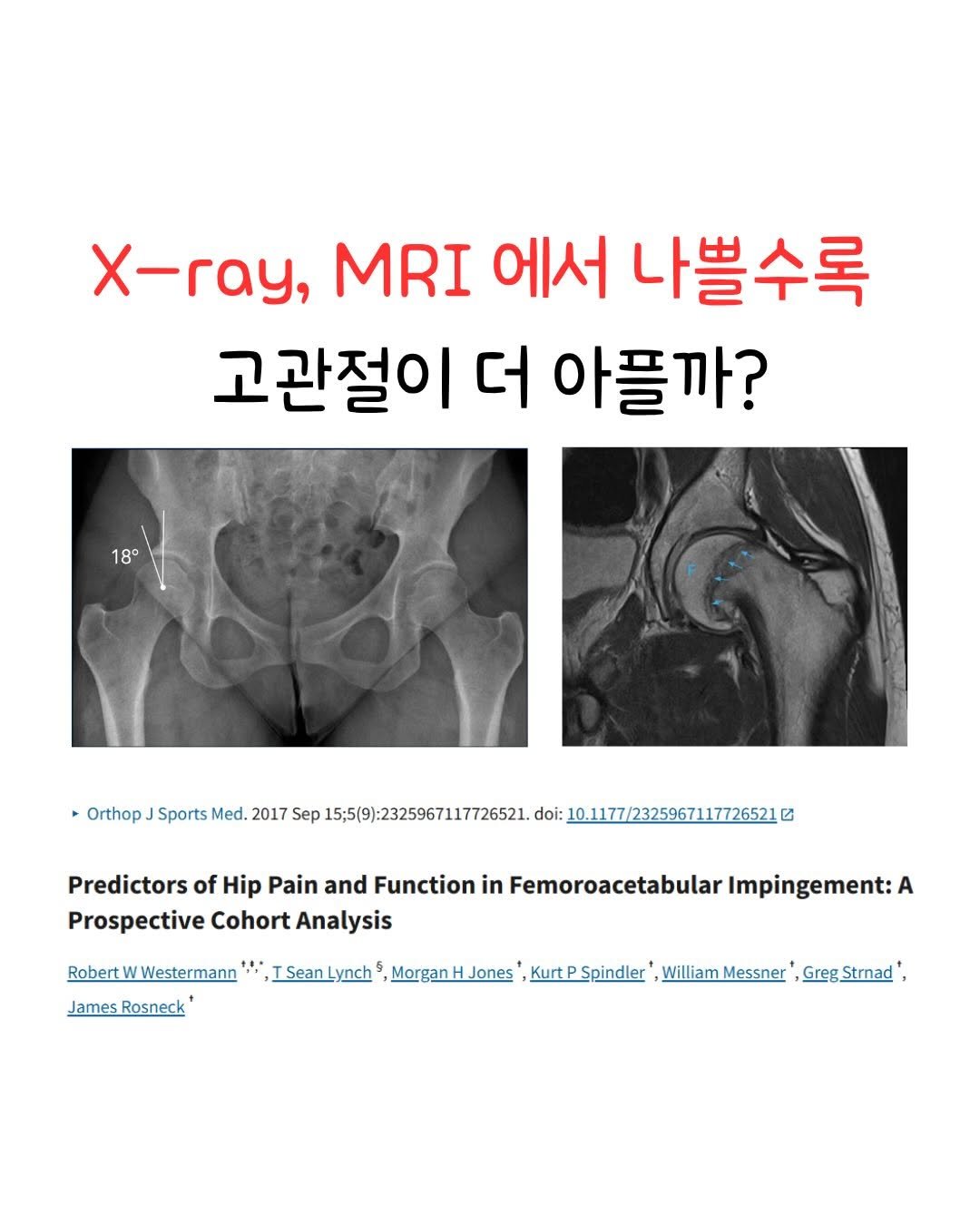 powertoyou0129 게시물 이미지: 구조적 손상 ≠ 통증 (FAI으로 인해 고관절 관절경 수술을 받는 환자들을 대상으로...