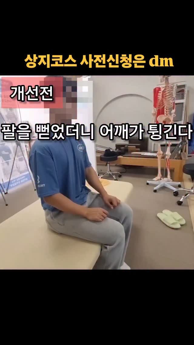 pt_beomjun 게시물 이미지: 견관절 굴곡에 상완골이 동시에
딸깍거리며 잠기는 패턴에 대한 관찰

이...