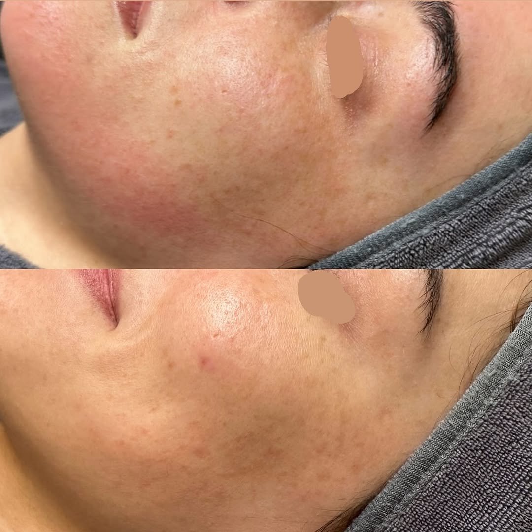 pure.glowskin 게시물 이미지: One Liquid Microneedling session & the...