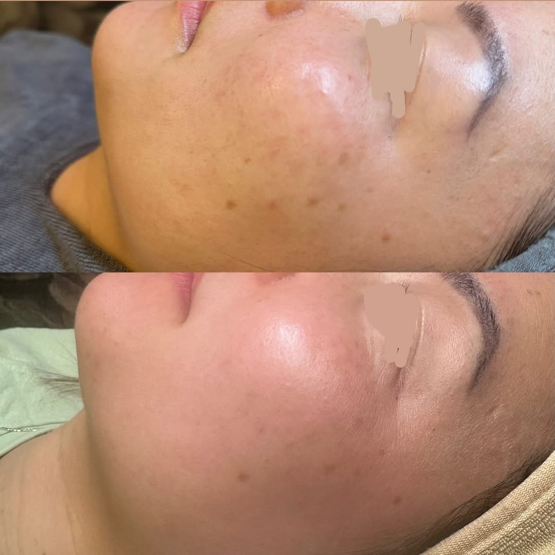 pure.glowskin 게시물 이미지: This transformation was achieved through a...