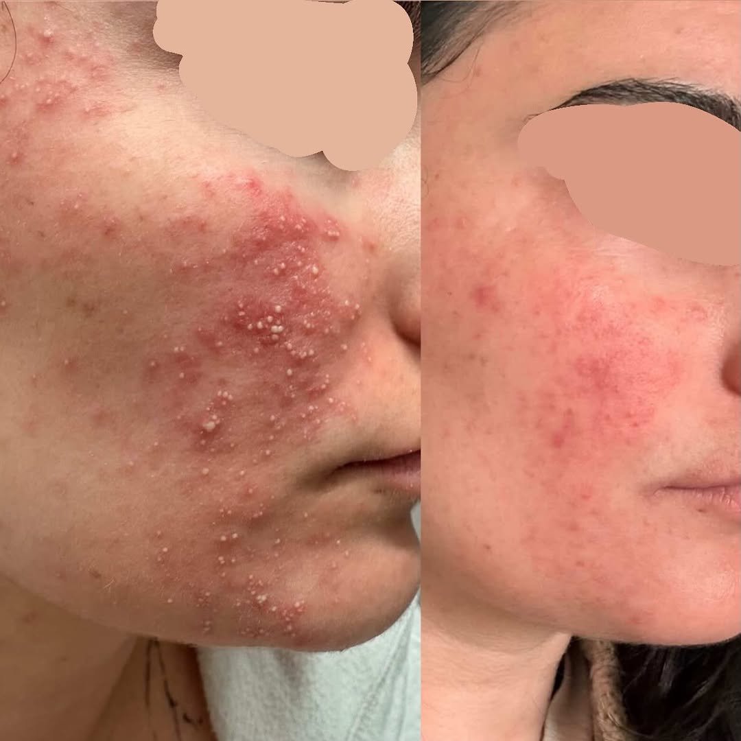 pure.glowskin 게시물 이미지: This transformation? ✨
100% home care.
No...