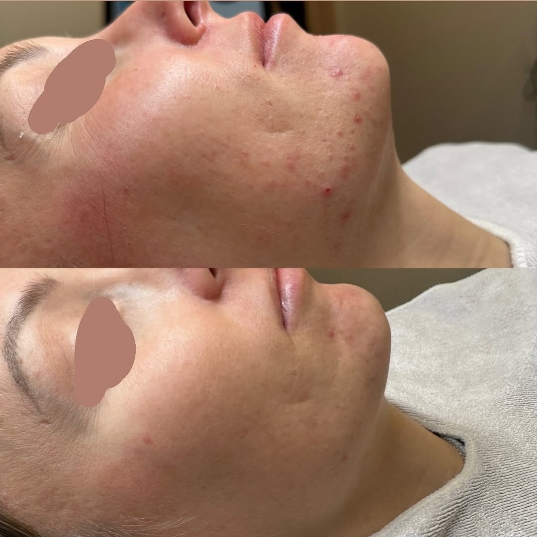 pure.glowskin 게시물 이미지: HydraFacial + Milk Chemical Peel Combo =
✔️...
