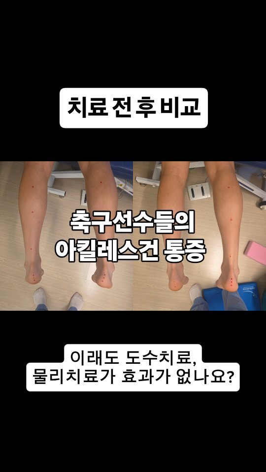 qandapt 게시물 이미지: 일자로 주행해야하는 아킬레스건이 휘어진다면?
축구선수들에게서 자주 나타나는...