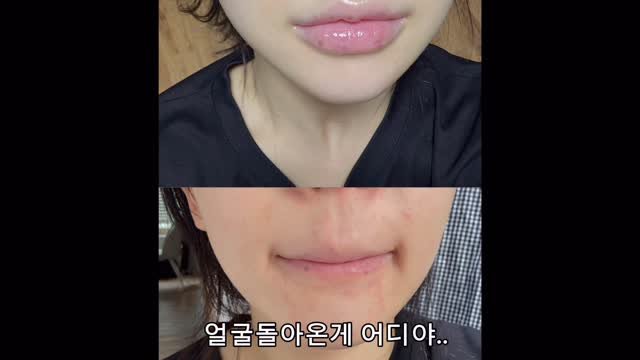 r_imrimm 게시물 이미지: 5월 16일 영상 세수 후 기본카메라 
현재는 증상 90% 완화🥹

(광고/협찬 X...