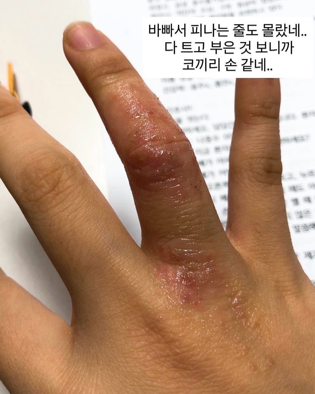 Photo by 간호사를 간호하는 간호사 | 오성훈 on December 19, 2025. May be an image of ointment and text that says '바빠서 피나는 줄도 몰랐네.. 다 트고 부은 것 보니까 코끼리 손 같네..'.