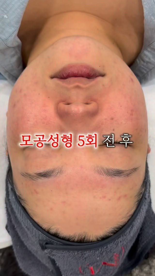 regain.skinrap 게시물 이미지: 엑소좀 모공성형 #슈퍼젝션

이제는 너무 유명해져서
먼 타지, 해외에서도 일부러...