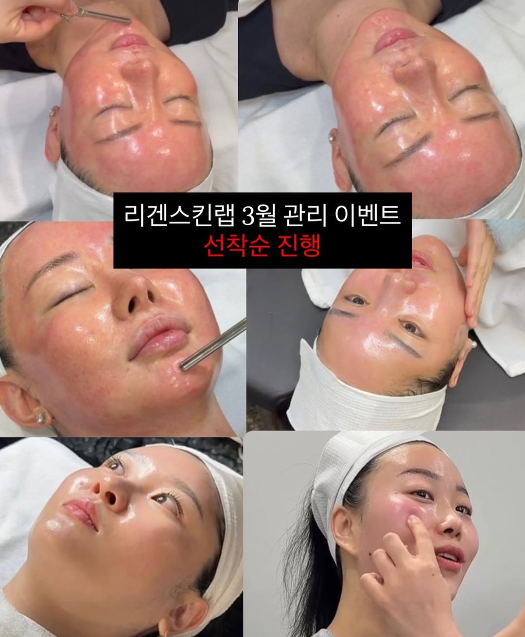 Photo by 모공 쫀쫀 깐달걀 피부 𝑵𝑶.𝟏 | 리겐스킨랩 원장 | 1:1 밀착 홈케어 코칭 | 슈퍼젝션 1위 on March 02, 2026. May be an image of text that says '리겐스킨랩 3월 관리 이벤트 선착순 진행'.