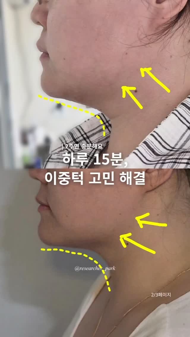 researcher_park 게시물 이미지: #광고 살 빠지는 건 좋은데 딱 하나 고민되는 게,
볼살, 턱살...