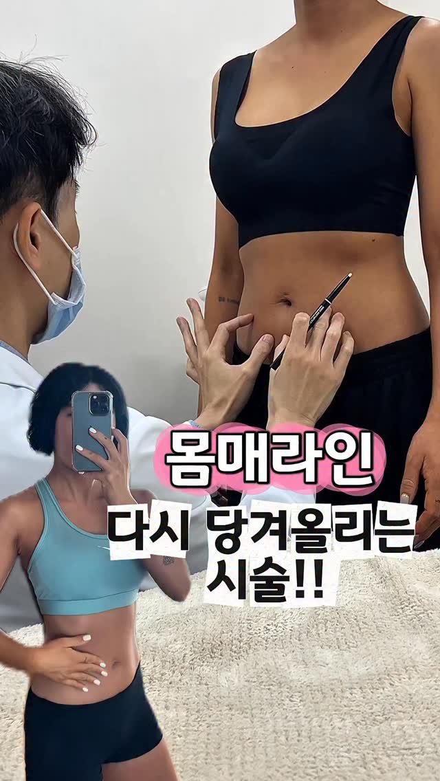 rudaya_nolja 게시물 이미지: 이제 얼굴말고 바디도
리프팅하세요❤️‍🔥

제가 얼마전에 코수술👃햇자나용
약을...