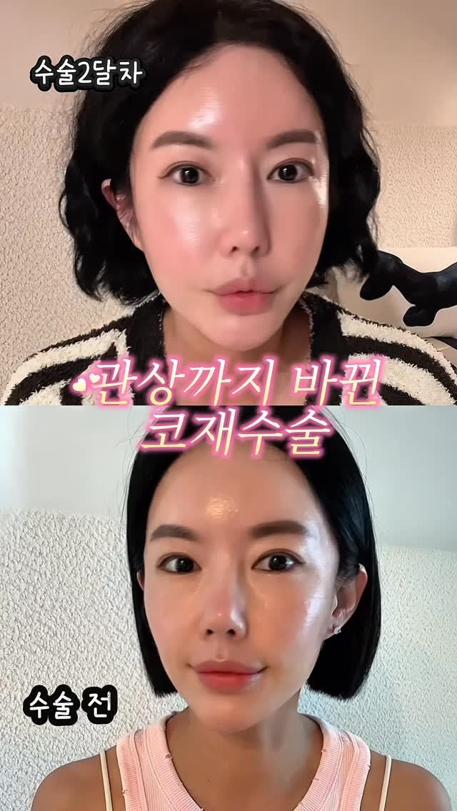 rudaya_nolja 게시물 이미지: 코도 이뻐졋는데! 일도 잘 풀려요😆

15년 전 코수술 부작용으로 휜코랑 
구축으로...