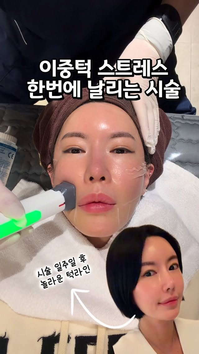 rudaya_nolja 게시물 이미지: 턱선정리 하나로 요즘 살 빠졌냐는 
소리 계속 듣고 있어요💗

영상 찍을 때마다...